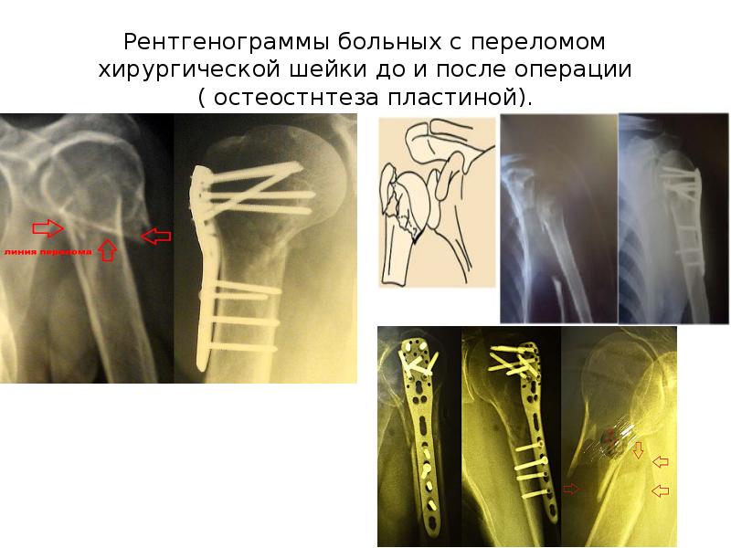 Признаки перелома плечевой кости