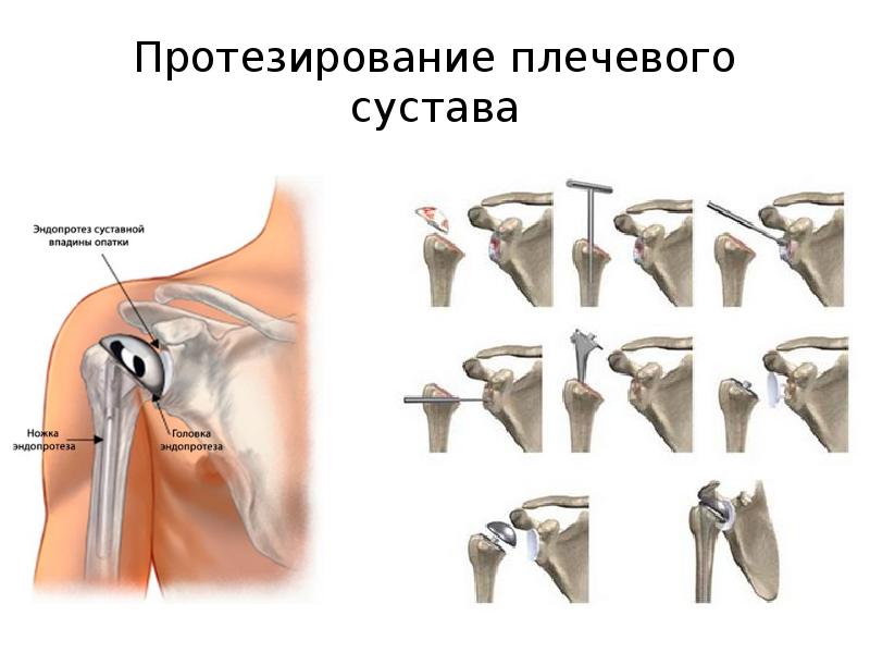 Повреждения плечевого пояса презентация