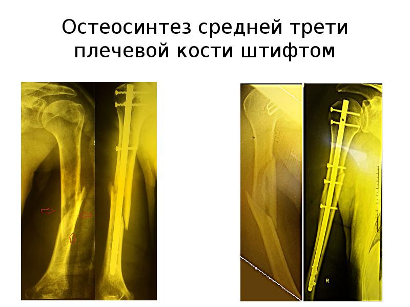 Переломы плечевой кости презентация