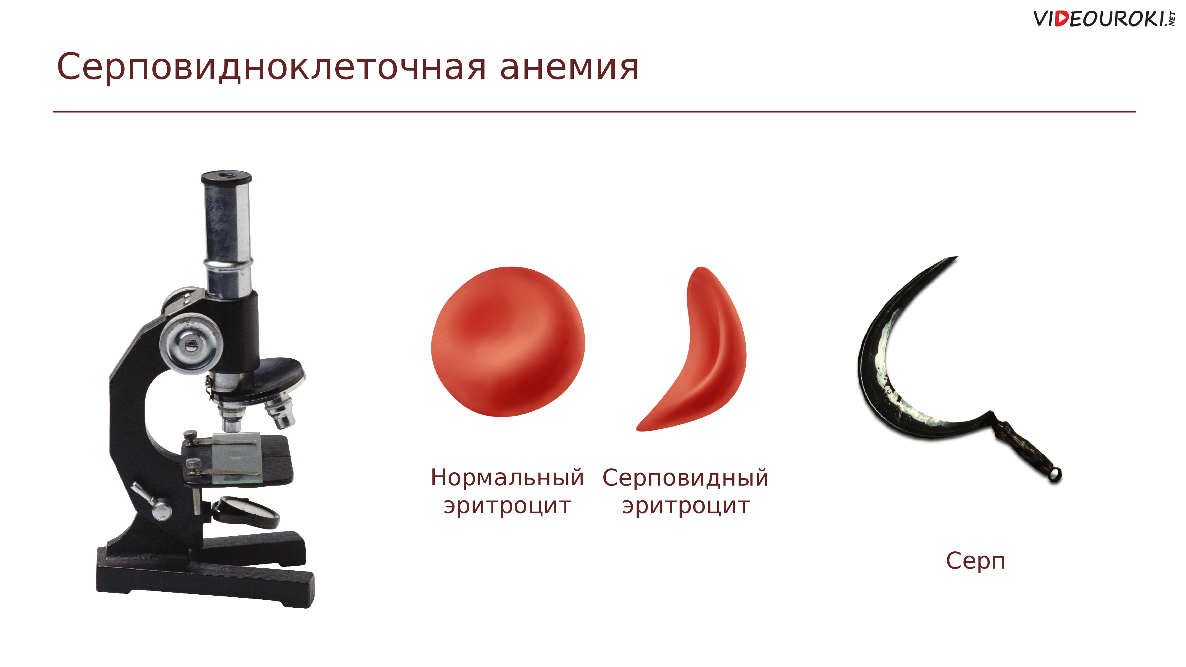 талассемия и серповидноклеточная анемия. серповидно клеточная анемия клиника. тип наследования серповидно-клеточной анемии. рождение ребенка с серповидноклеточной анемией вид изменчивости. серповидноклеточная анемия мутация.