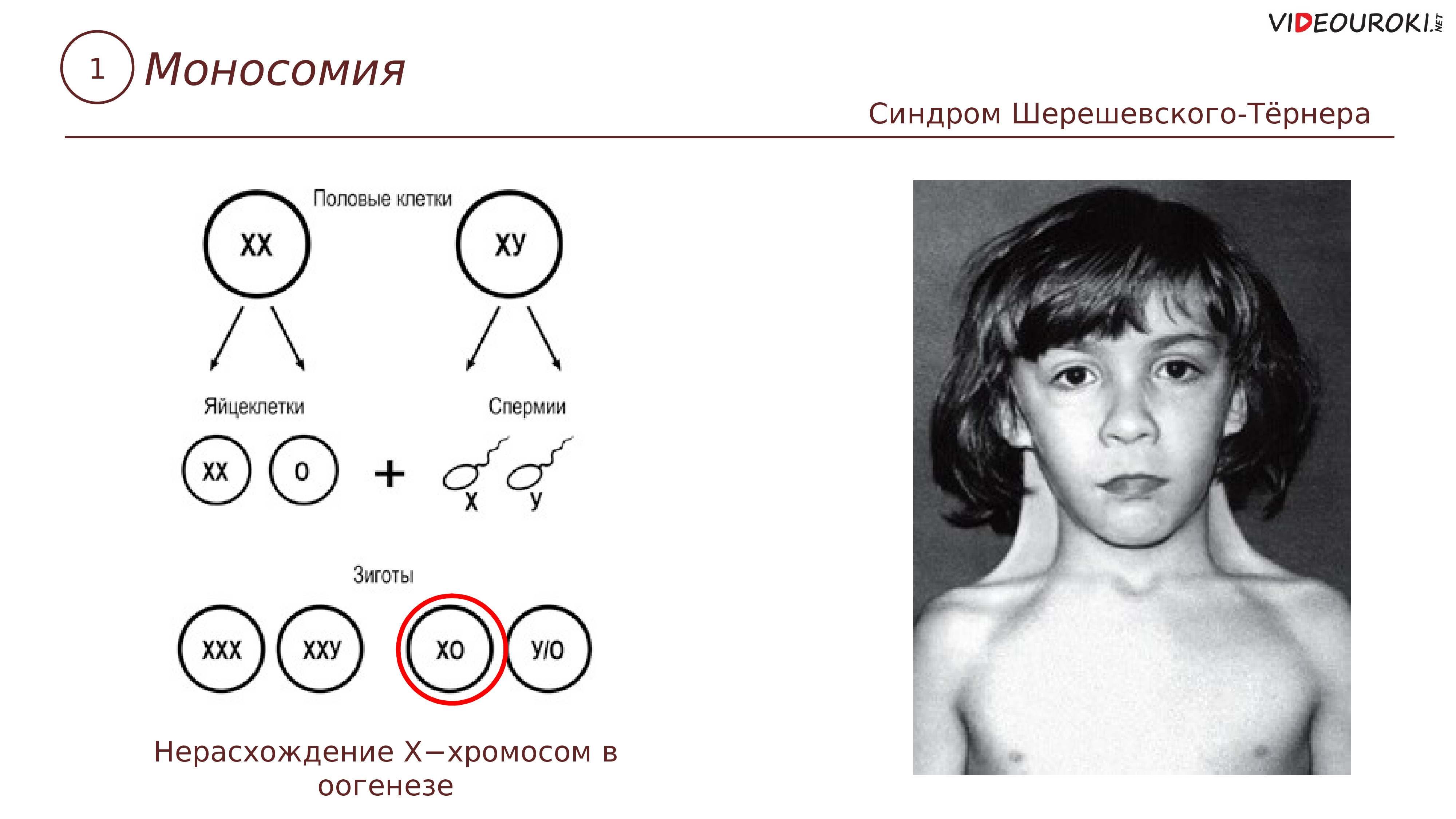 Болезнь шерешевского тернера картинки