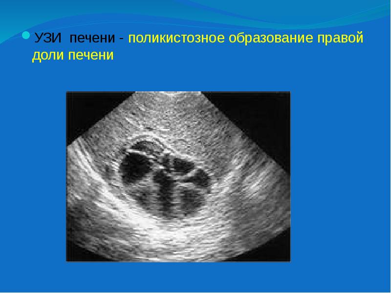 Образование правой. Образование правой доли печени. Поликистозные образования печени. Образование в правой доле печени при УЗИ. Доли правой доли печени на УЗИ.