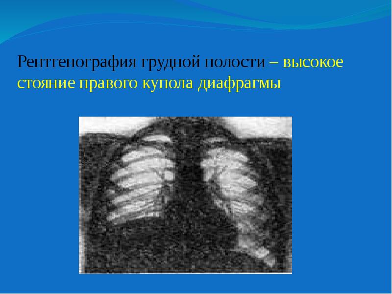 Купол диафрагмы. Высокое стояние диафрагмы на рентгене. Высокое стояние правого купола диафрагмы. Высокое стояние купола диафрагмы рентген. Высокое стояние левого купола диафрагмы.