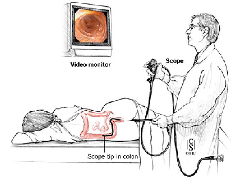 Колоноскопия кишечника картинки