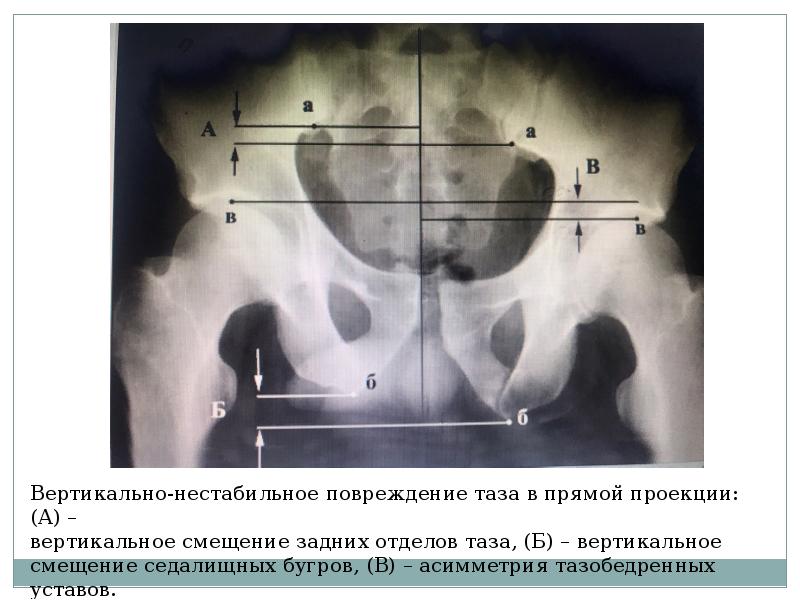 Повреждения таза презентация