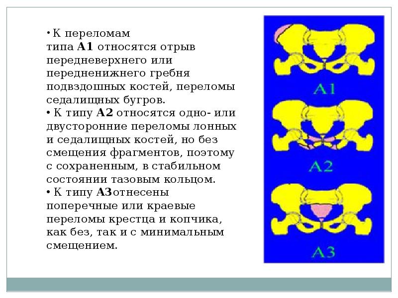 Переломы костей таза презентация