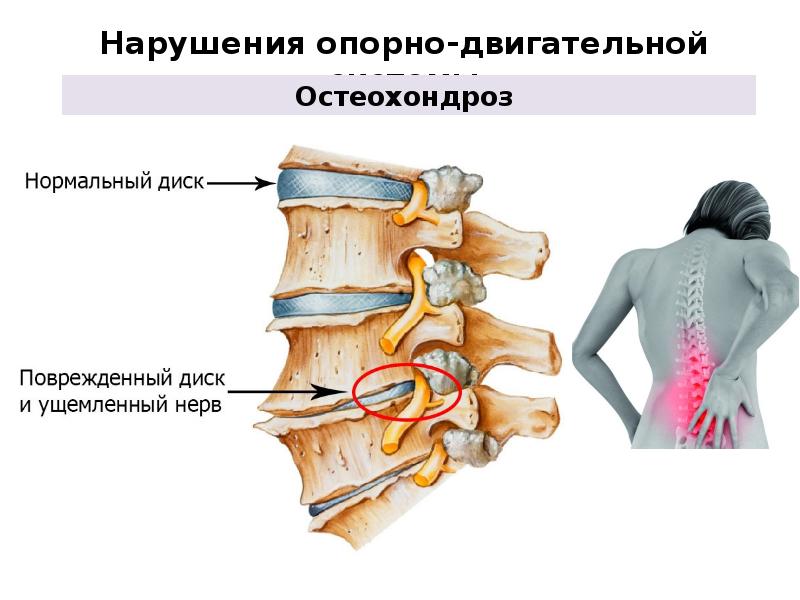 Опорные нарушения. Что такое нарушения опорнодвигательногй системы. Нарушение опорно двигательной системы. Заболевания опорно-двигательной системы презентация. Заболевание опорнодвирюгатеььной системы.