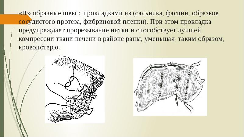 «П» образные швы с прокладками из (сальника, фасции, обрезков сосудистого протеза,