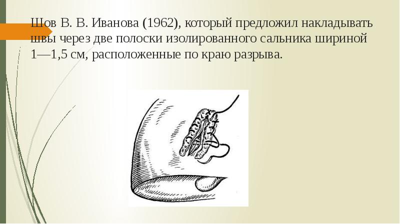 Шов В. В. Иванова (1962), который предложил накладывать швы через две