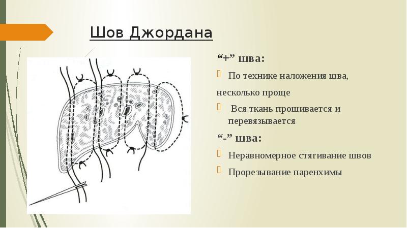 Шов Джордана “+” шва:  По технике наложения шва, несколько проще