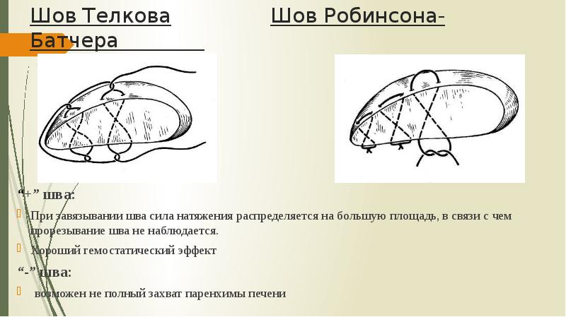 Шов Телкова        Шов Робинсона-Батчера