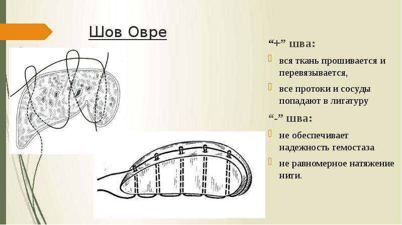 Шов Овре “+” шва: вся ткань прошивается и перевязывается,  все