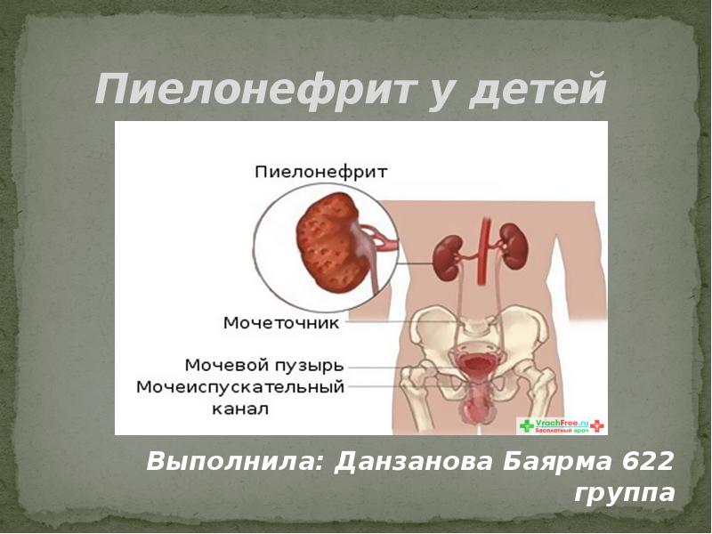 Пиелонефрит у детей презентация педиатрия