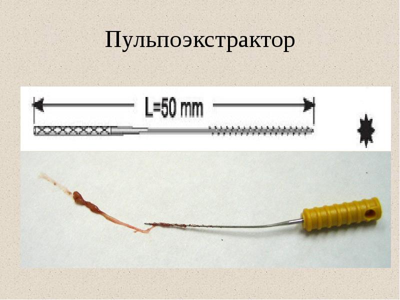 Пульпоэкстрактор