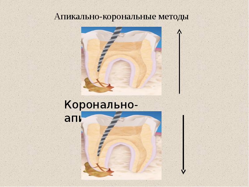 Апикально-корональные методы