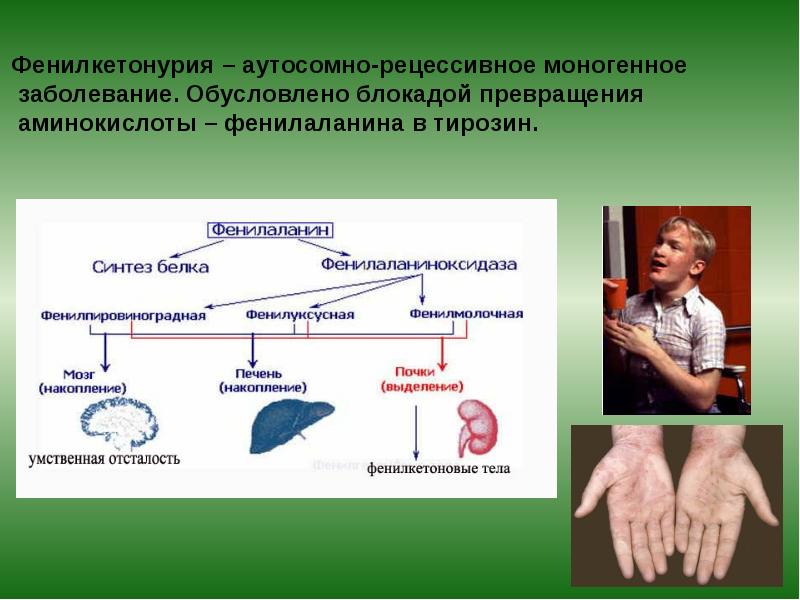 Фенилкетонурия – аутосомно-рецессивное моногенное заболевание. Обусловлено блокадой превращения Фенилкетонурия – аутосомно-рецессивное моногенное заболевание. Обусловлено блокадой превращения