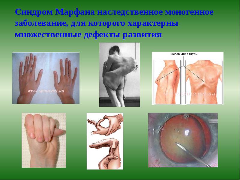 Синдром Марфана наследственное моногенное заболевание, для которого характерны множественные дефекты развития Синдром Марфана наследственное моногенное заболевание, для которого характерны множественные дефекты развития