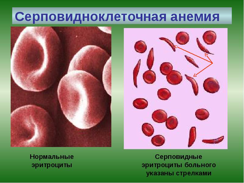 Серповидноклеточная анемия Серповидноклеточная анемия