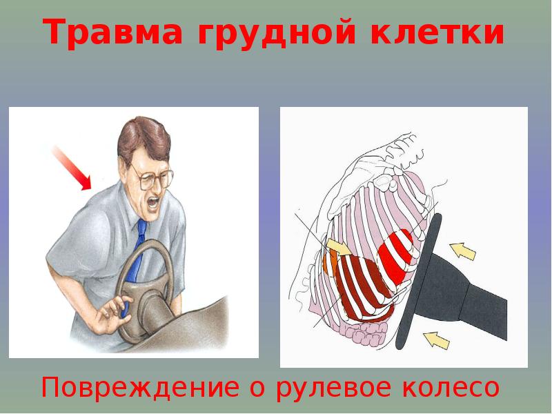 Травмы грудной клетки хирургия