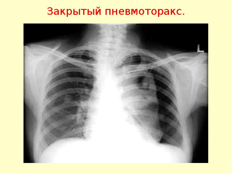 Презентация пневмоторакс и гемоторакс