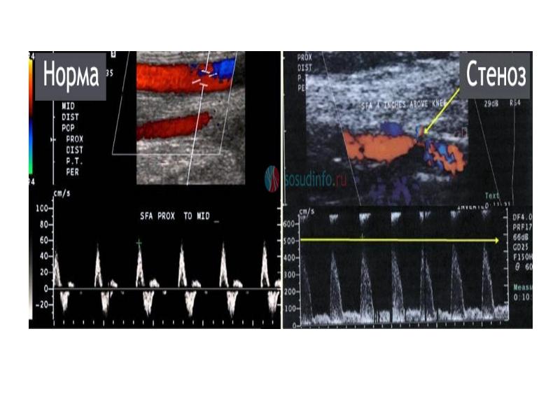 Презентация ультразвуковое исследование сосудов