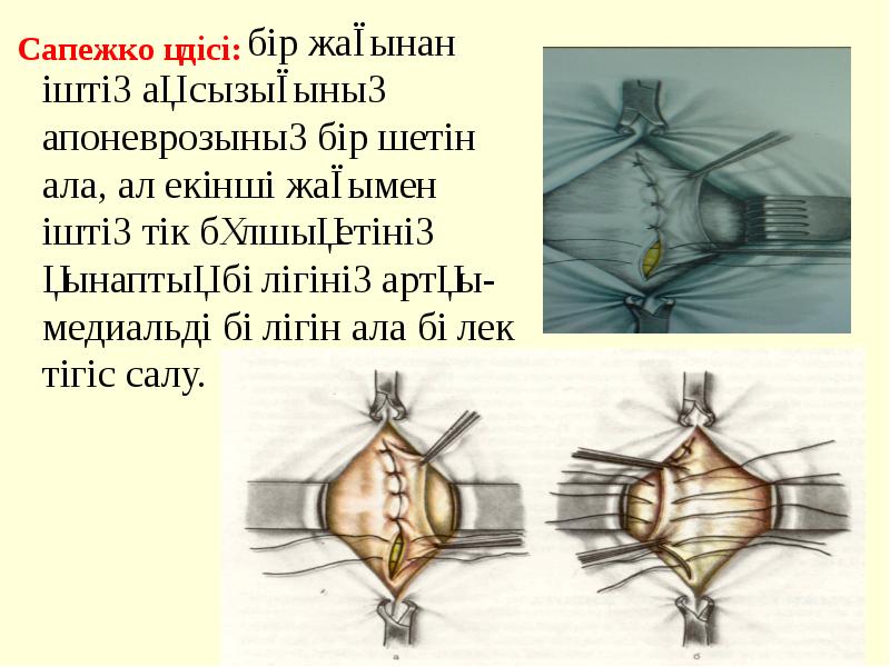 Пластика грыж по сапежко