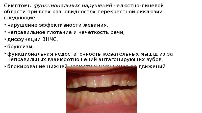 Перекрестный прикус схема лечения у взрослого