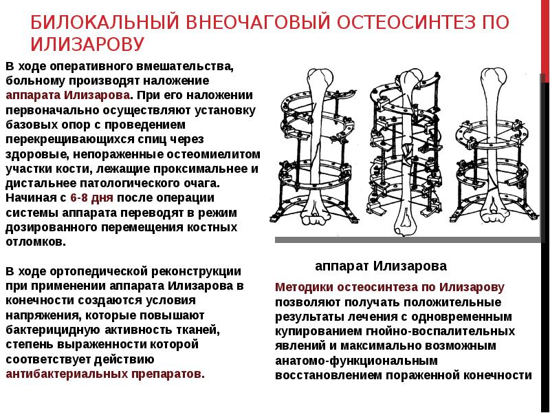 Аппарат илизарова презентация