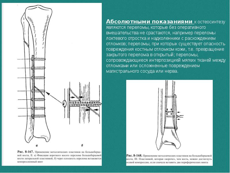 К открытым переломам относятся