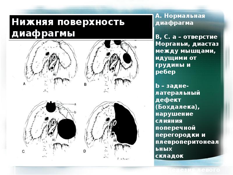 Грыжа бохдалека. Задняя диафрагмальная грыжа Бохдалека. Грыжа Бохдалека кт диафрагмы. Грыжа Морганьи Ларрея на кт. Диафрагмальная грыжа Бохдалека справа.