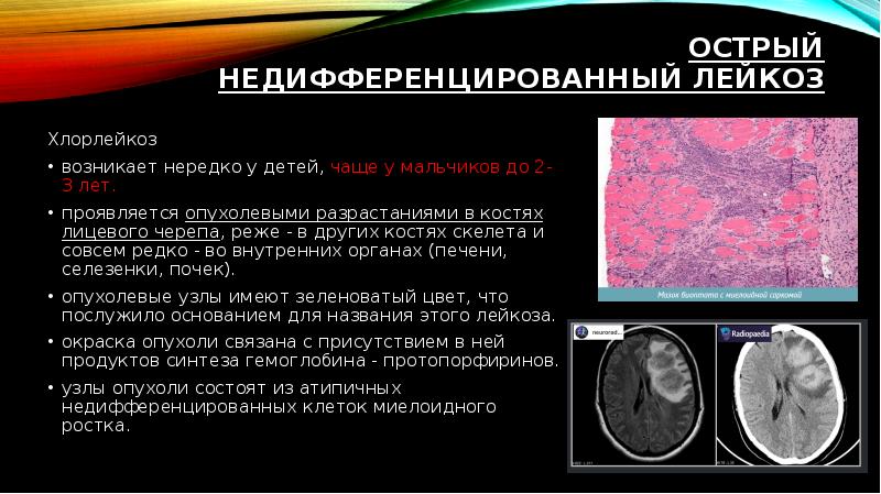 Острый миелобластный лейкоз презентация