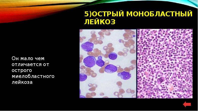 Острый миелолейкоз презентация