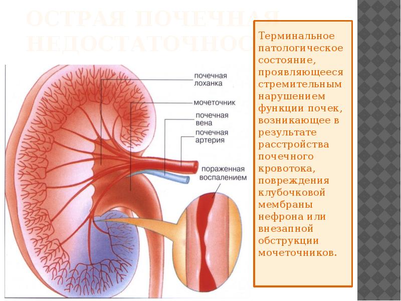 Острая и хроническая почечная недостаточность у детей презентация