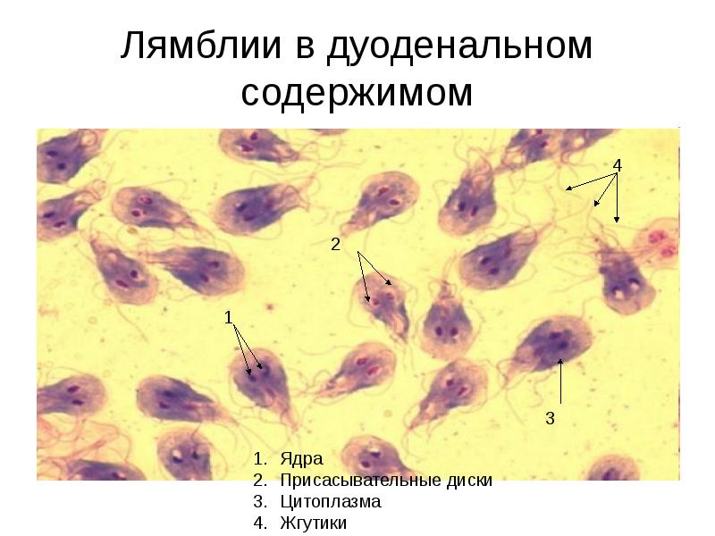 Лямблии в дуоденальном содержимом