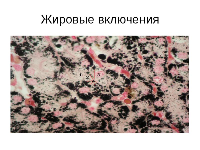 Жировые включения