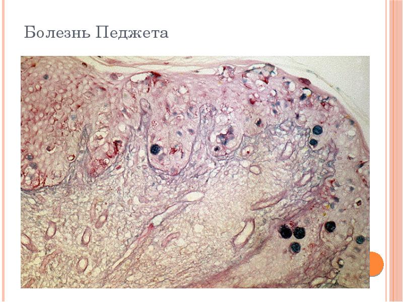 Презентация болезнь педжета