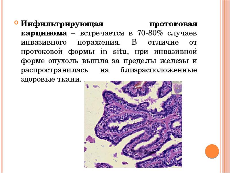 Инвазивная карцинома молочной железы неспецифического типа. Инвазивный протоковый рак что это. Инвазивный протоковый рак что это. Инвазивный протоковый рак что это. Протоковая карцинома молочной железы микропрепарат.