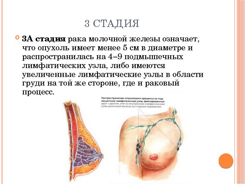 Молочная железа стадии. Размер опухоли молочной железы по стадиям. Опухоль молочной железы 4 стадии. Опухоль 3 стадия молочной железы.