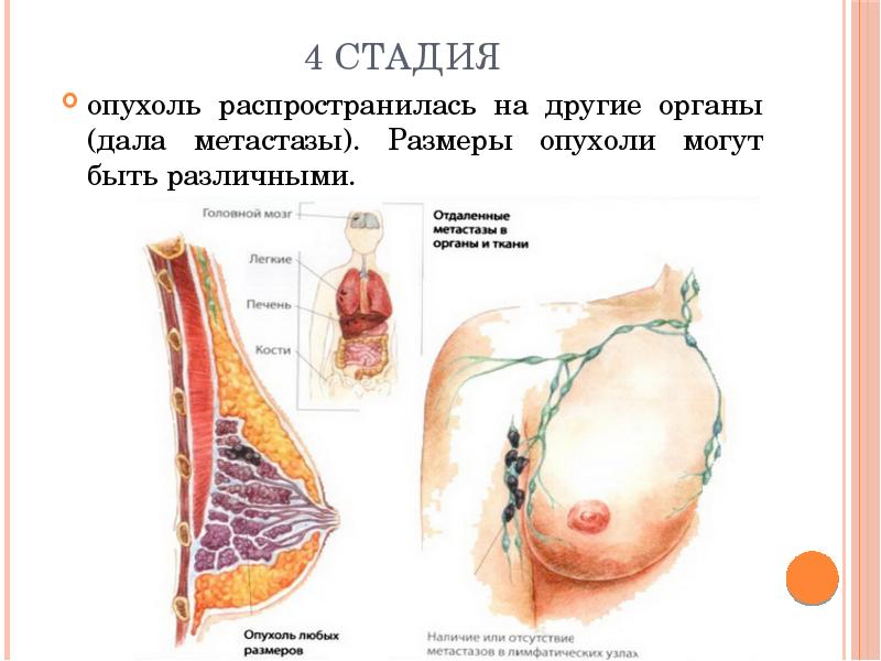 Последняя стадия рака груди фото ГБОУ ВПО "ПГМУ им.ак. Е.А.Вагнера" Минздрава России Кафедра патологической