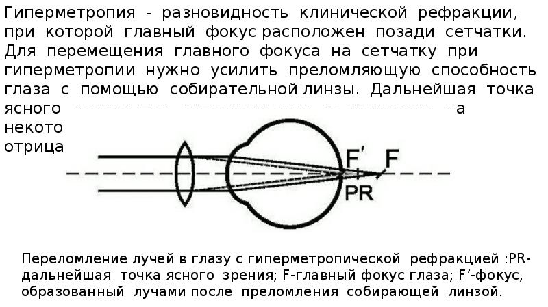 Гиперметропия слабой стенки