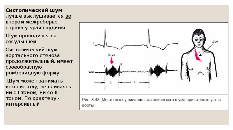Систолический шум лучше выслушивается во втором межреберье справа у&nbsp;края грудины Систолический