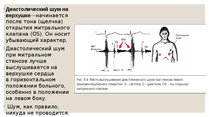 Диастолический шум на верхушке—начинается после тона (щелчка) открытия митрального клапана (OS).