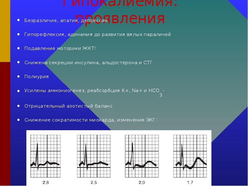 Гипокалиемия на экг картинки