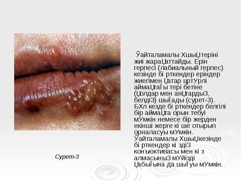 Қайталамалы ұшық теріні жиі жарақаттайды. Ерін герпесі (лабиальный герпес) кезінде бөрткендер Қайталамалы ұшық теріні жиі жарақаттайды. Ерін герпесі (лабиальный герпес) кезінде бөрткендер