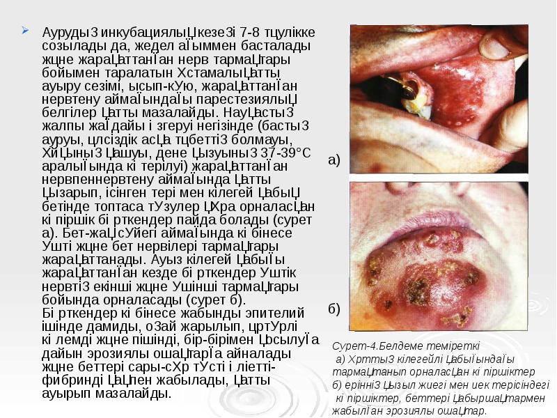 Аурудың инкубациялық кезеңі 7-8 тәулікке созылады да, жедел ағыммен басталады және Аурудың инкубациялық кезеңі 7-8 тәулікке созылады да, жедел ағыммен басталады және