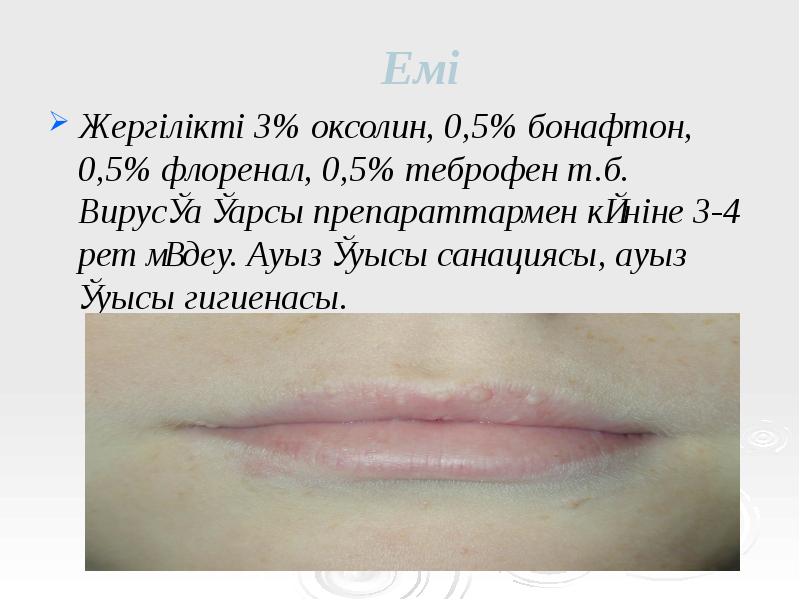 Емі
Жергілікті 3% оксолин, 0,5% бонафтон, 0,5% флоренал, 0,5% теброфен т.б. Емі
Жергілікті 3% оксолин, 0,5% бонафтон, 0,5% флоренал, 0,5% теброфен т.б.