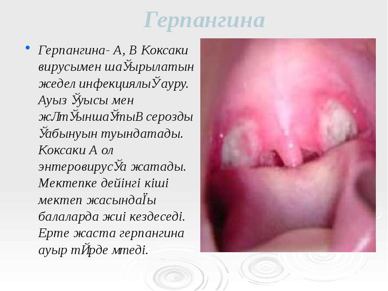 Герпангина
Герпангина- А, В Коксаки вирусымен шақырылатын жедел инфекциялық ауру. Ауыз Герпангина
Герпангина- А, В Коксаки вирусымен шақырылатын жедел инфекциялық ауру. Ауыз