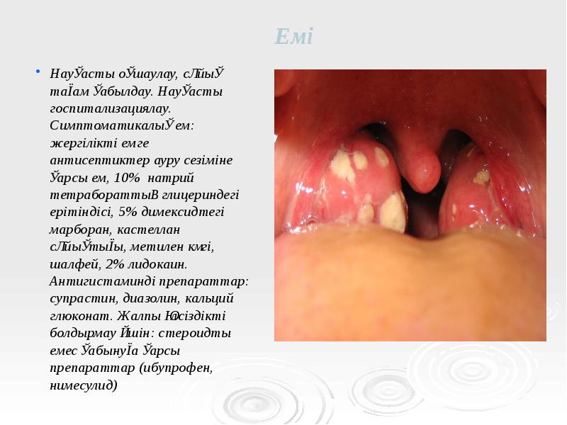Емі
Науқасты оқшаулау, сұйық тағам қабылдау. Науқасты госпитализациялау. Симптоматикалық ем: жергілікті Емі
Науқасты оқшаулау, сұйық тағам қабылдау. Науқасты госпитализациялау. Симптоматикалық ем: жергілікті