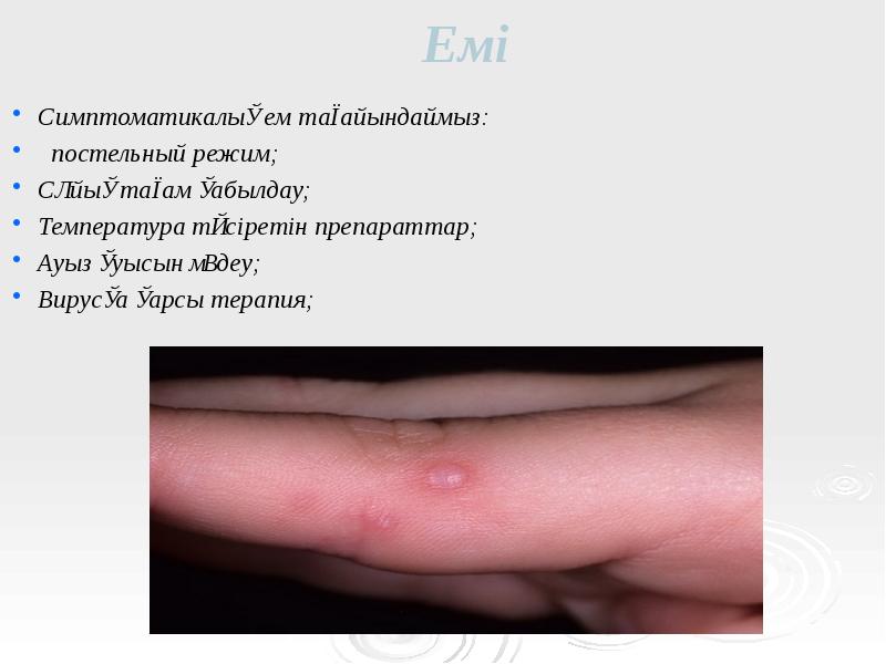 Емі
Симптоматикалық ем тағайындаймыз:
постельный режим;
Сұйық тағам қабылдау;
Температура Емі
Симптоматикалық ем тағайындаймыз:
постельный режим;
Сұйық тағам қабылдау;
Температура