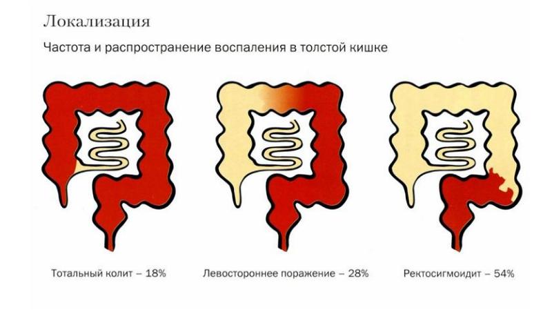 Код спастический колит. Профилактика язвенного колита. Код спастический колит. Код спастический колит. Неспецифический колит мкб.